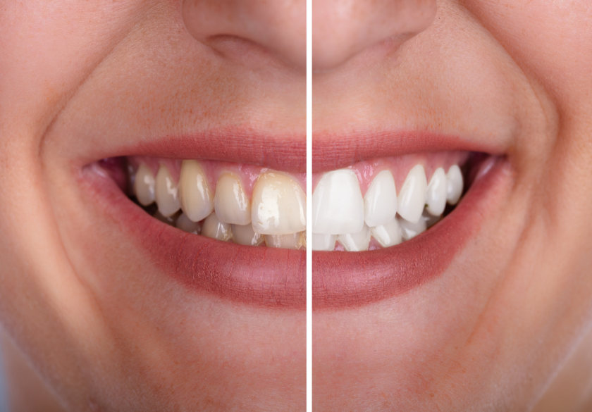 A close-up of a person’s smile, with the left side showing yellowed teeth and the right side showing whitened teeth, serves as compelling before-and-after photos for your website, illustrating a dramatic teeth whitening transformation.